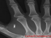 rfid-chip-implanted2
